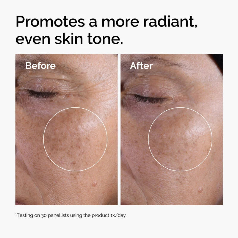 The Ordinary Glycolic Acid skin before and after