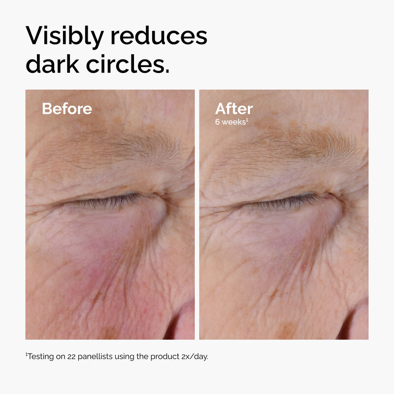 The Ordinary Caffeine Solution before and after results on under eye dark circles