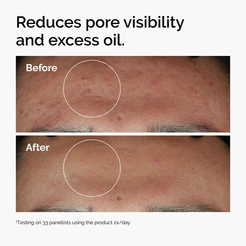 The Ordinary Niacinamide serum skin before and after